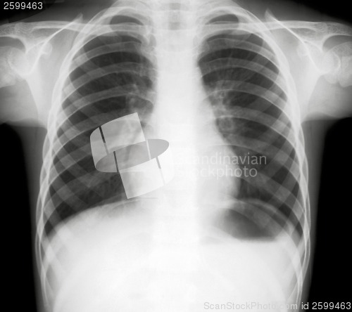 Image of X-ray of lungs