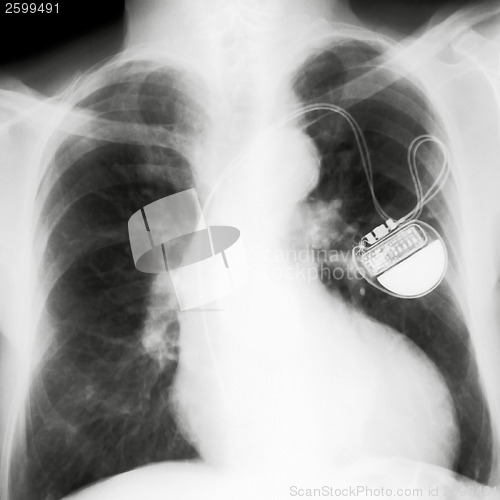 Image of X-rayed chest