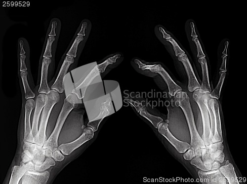 Image of X-rayed hands