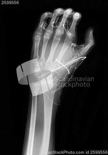 Image of X ray image of hand