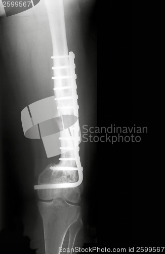 Image of X-Rayed Thigh
