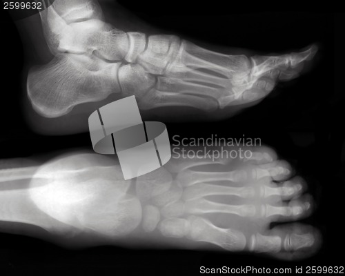 Image of Foot-X-Ray