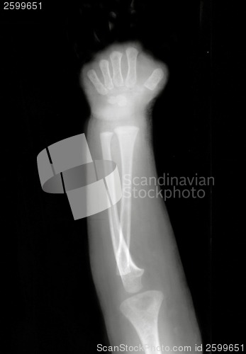 Image of Forearm