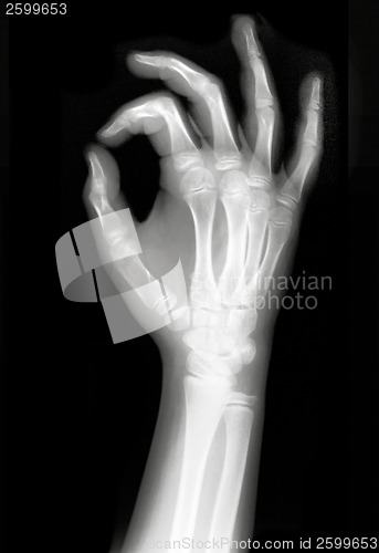 Image of X-rayed Hand