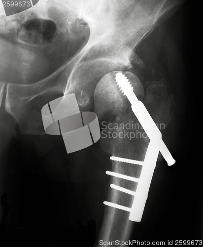 Image of X-rayed Hip