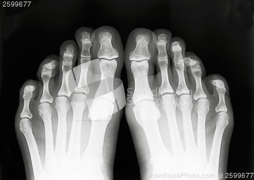 Image of Foot fingers