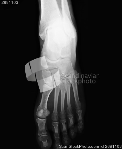 Image of foot  xray