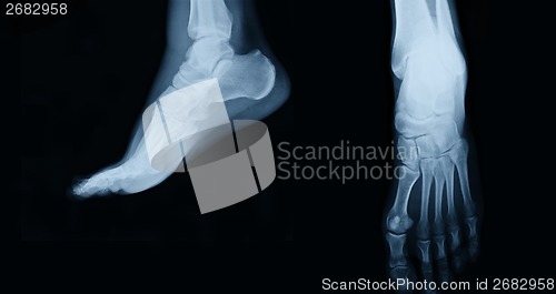 Image of foot  xray