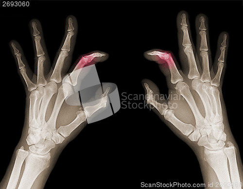 Image of X-ray of hands