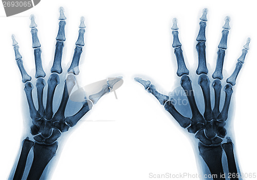 Image of X-ray  hands