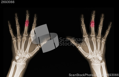 Image of X-ray of hands