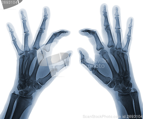 Image of X-ray  hands