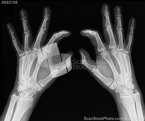 Image of X-ray of hands