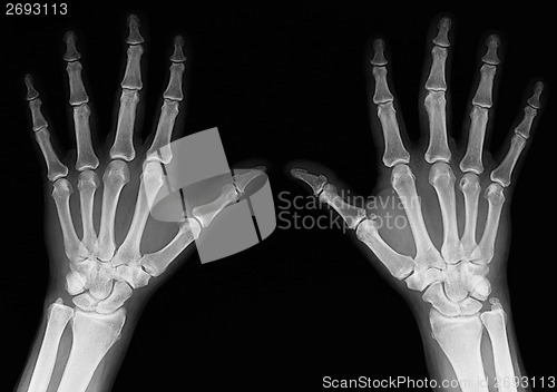 Image of X-ray of hands