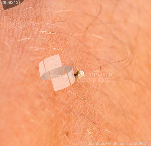 Image of Bee Sting Stuck In Human Skin