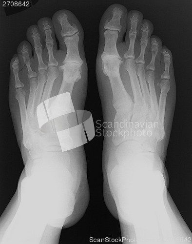 Image of X-ray foot