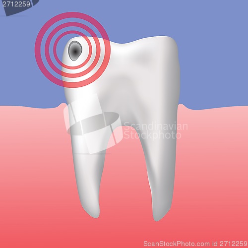 Image of hole in the tooth