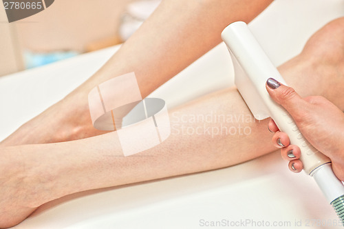 Image of laser epilation