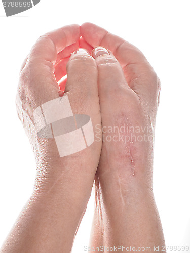 Image of Scars on hands