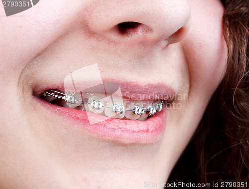 Image of Woman with brackets 