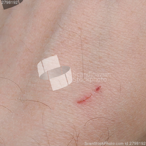 Image of Hand scar
