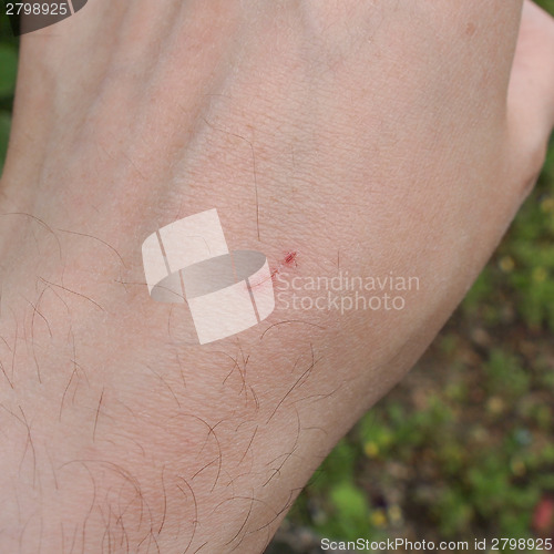 Image of Hand scar