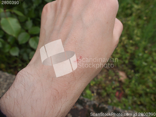 Image of Hand scar