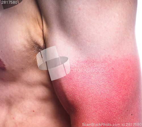 Image of Sunburn male biceps