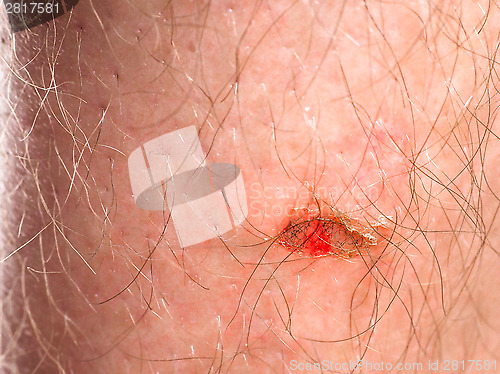 Image of Wound with blood