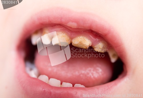 Image of bad teeth