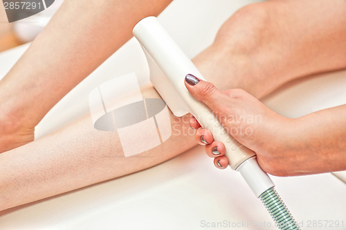 Image of laser epilation