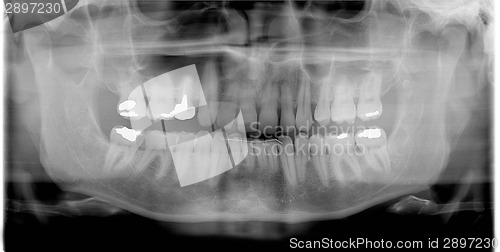 Image of rtg (x-ray)  photo of man teeth 