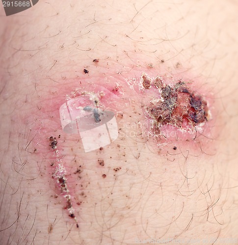 Image of wound