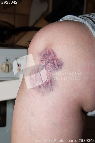 Image of Bruising