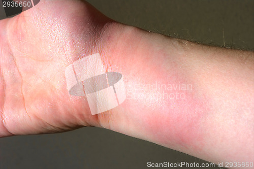 Image of Infection