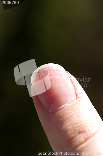 Image of Bloody thumb