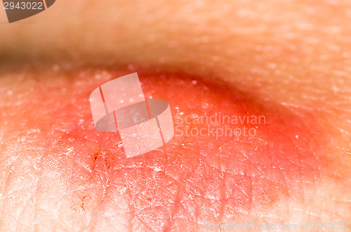 Image of Mosquito bite