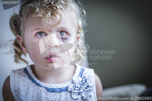 Image of Sad, Bruised and Frightened Little Girl