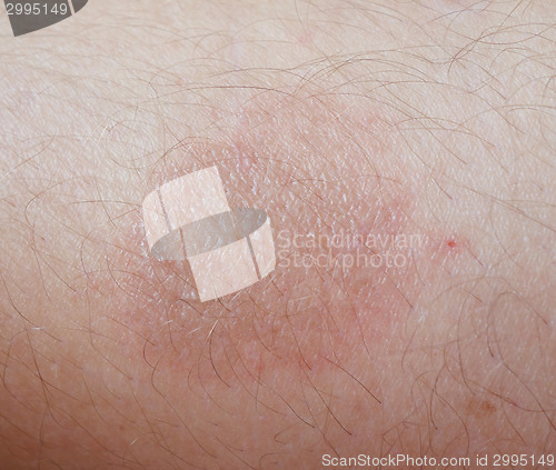 Image of burn on skin