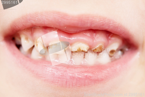 Image of bad teeth