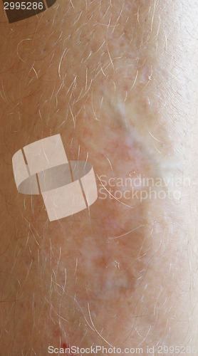 Image of scar on skin