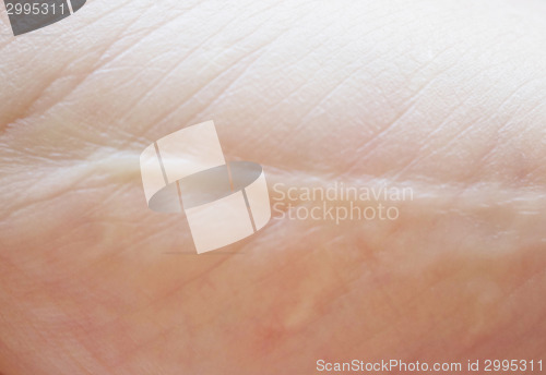 Image of scar on skin