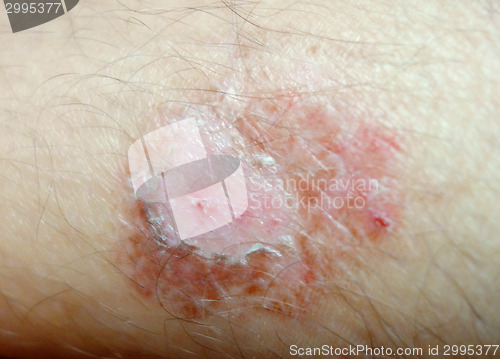 Image of burning skin