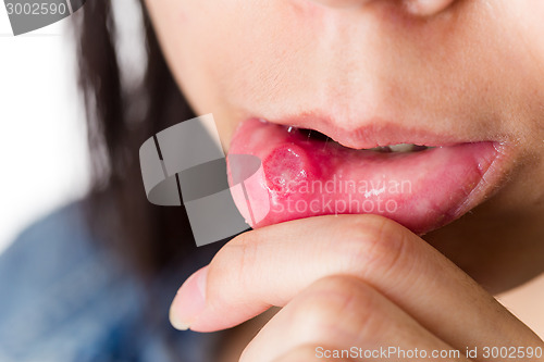 Image of Woman with aphthous stomatitis