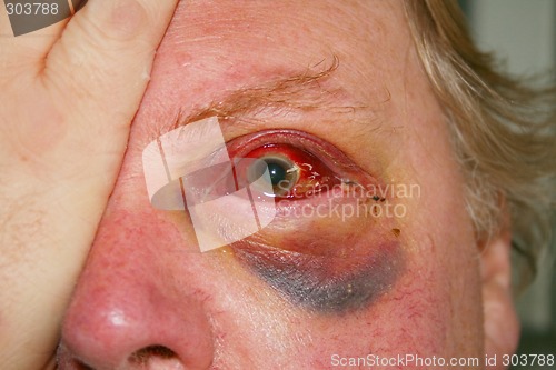 Image of damaged eye
