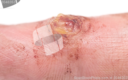 Image of wart