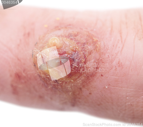 Image of wart