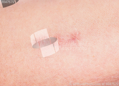 Image of Closeup of redness around healing stitches on skin