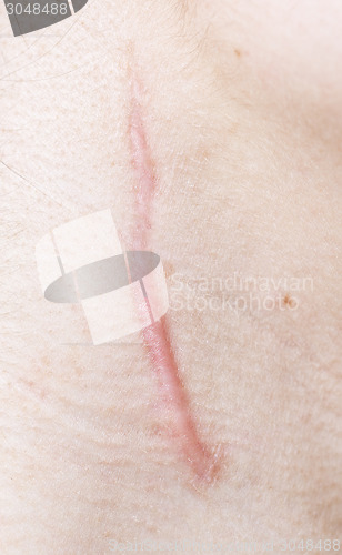 Image of scar