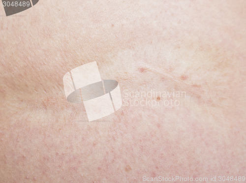 Image of scar
